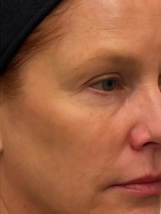 Before treatment