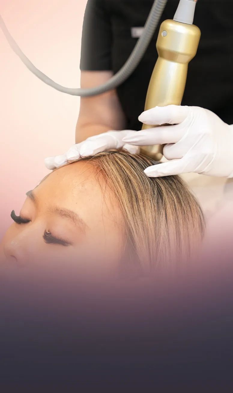 Sylfirm X RF Microneedling for Scalp treatment at Toronto medical spa - Sylfirm X strengthens follicles and improves absor...